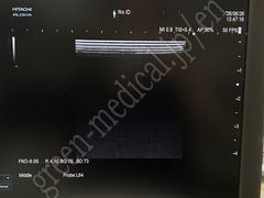 Hitachi Ultrasound Diagnostic System