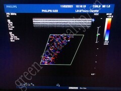 PHILIPS Ultrasound Color Doppler