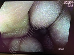 PENTAX Video Colonoscope