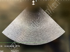Hitachi Ultrasound Diagnostic System