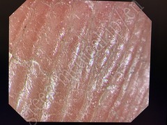 OLYMPUS Video Colonosope