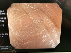 OLYMPUS Video Colonoscope