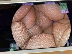 FUJIFILM Video Processor & Laser Lightsource