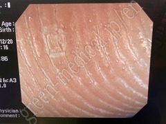 OLYMPUS Video Colonoscope