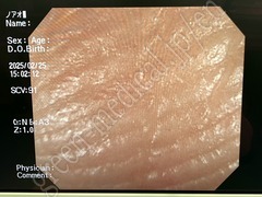 OLYMPUS Video Colonosope