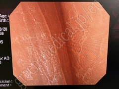 OLYMPUS Video Colonoscope