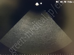 Hitachi Color Doppler Ultrasound System