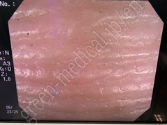 OLYMPUS Video Colonoscope
