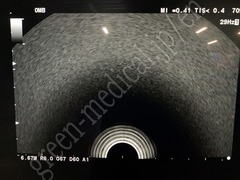 Hitachi Ultrasound Color Doppler