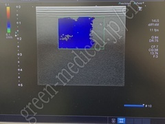 TOSHIBA Ultrasound Color Doppler