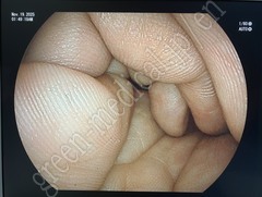 FUJIFILM Transnasal Gastroscope