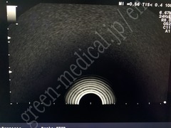 Hitachi Ultrasound Color Doppler