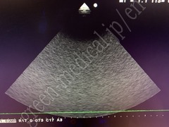 Hitachi Ultrasound Color Doppler