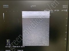 Hitachi Ultrasound Diagnostic System