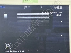 Hitachi Ultrasound Color Doppler