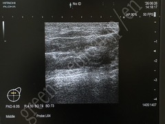 Hitachi Ultrasound Diagnostic System