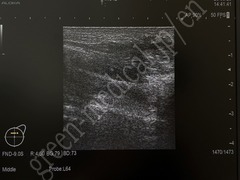 Hitachi Ultrasound Diagnostic System