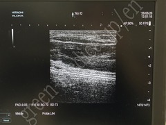 Hitachi Ultrasound Diagnostic System