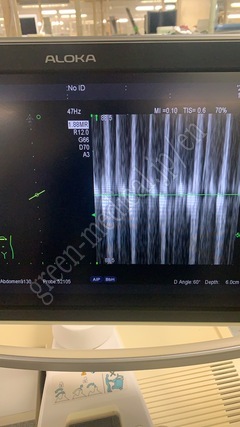 Hitachi Ultrasound Color Doppler