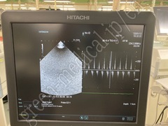 Hitachi Ultrasound Diagnostic System