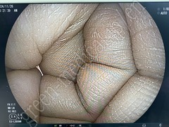 FUJIFILM Video Transnasal Gastroscope