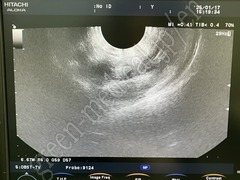 Hitachi Color Doppler Ultrasound System