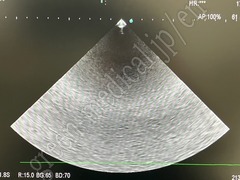 Hitachi Diagnostic  Ultrasound System