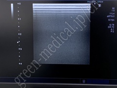 TOSHIBA Ultrasound Color Doppler
