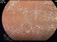 FUJIFILM Video Colonoscope