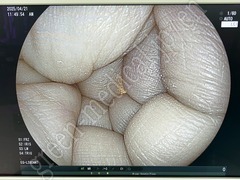 FUJIFILM Video Processor & Laser Lightsource