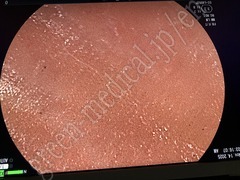 FUJIFILM Video Colonoscope