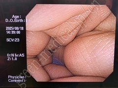 OLYMPUS Video Colonoscope