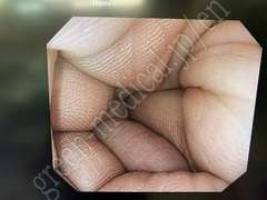 OLYMPUS Video Gastroscope