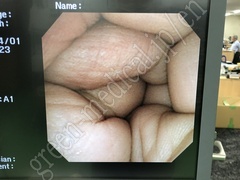 OLYMPUS Video Transnasal Gastroscope