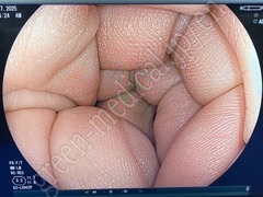 FUJIFILM Video Colonoscope