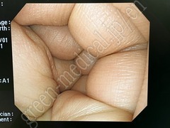 OLYMPUS Video Gastroscope