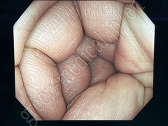 OLYMPUS Video Colonoscope