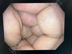 OLYMPUS Video Gastroscope