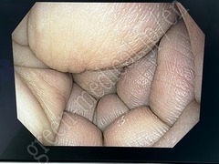 OLYMPUS Video Gastroscope