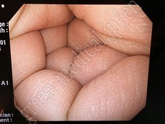 OLYMPUS Video Gastroscope