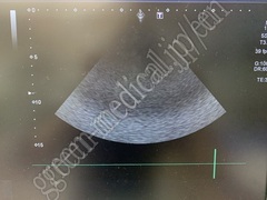 TOSHIBA Color Doppler Ultrasound