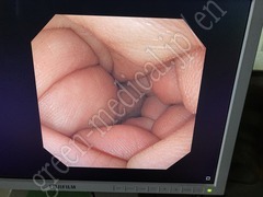 OLYMPUS Video Transnasal Gastroscope