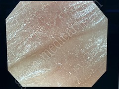 OLYMPUS Video Colonoscope