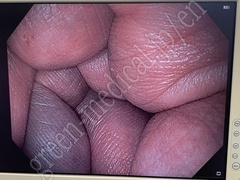 OLYMPUS EXERA III Processor & Light Source