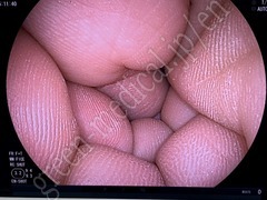 FUJIFILM Double Balloon Endoscope