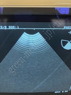 Hitachi Ultrasound