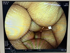 FUJIFILM Video Transnasal Gastroscope