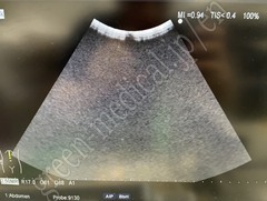 Hitachi Ultrasound Color Doppler