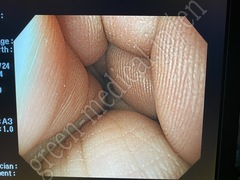 OLYMPUS Video Gastroscope