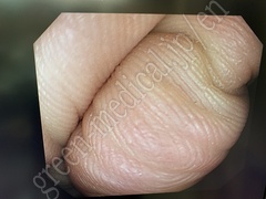 OLYMPUS Video Gastroscope